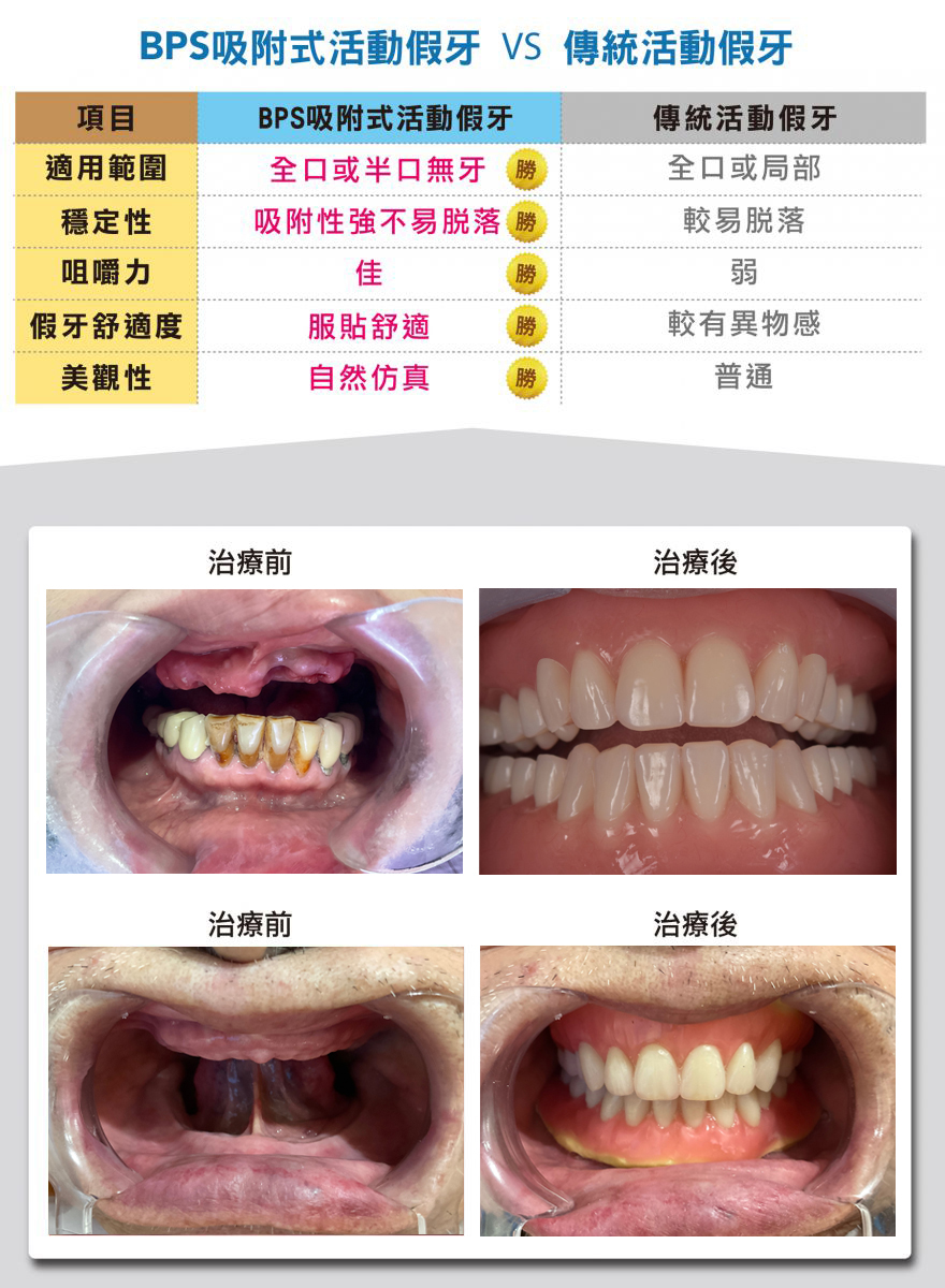 BPS吸附式活動假牙VS傳統活動假牙
