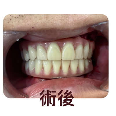 allon4植牙后