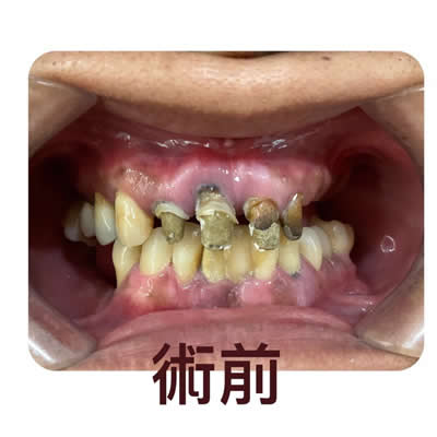 allon4植牙前