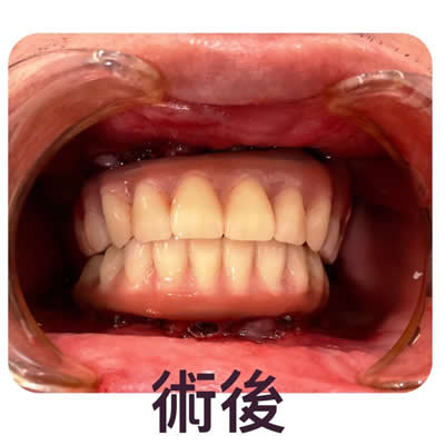 allon4植牙后