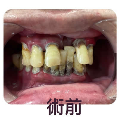 allon4植牙前