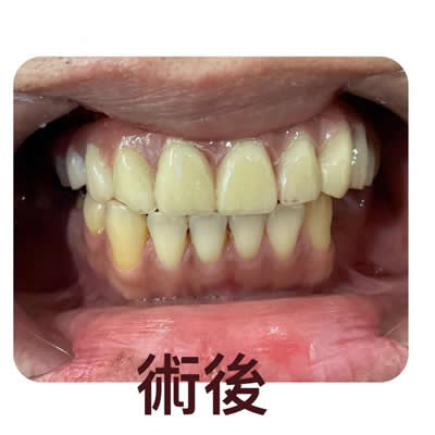 allon4植牙后