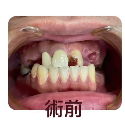 allon4植牙前