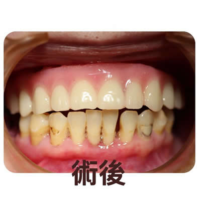 allon4植牙后