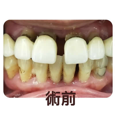 allon4植牙前