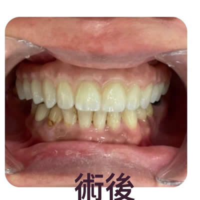 allon4植牙后