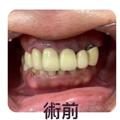allon4植牙前